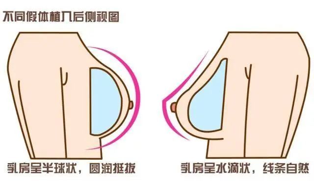 为什么说选好医生是隆胸的关键一步? 图片-4