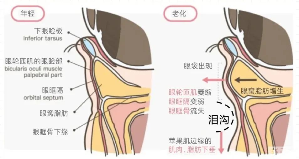 为什么年纪轻轻就有泪沟? 图片-4