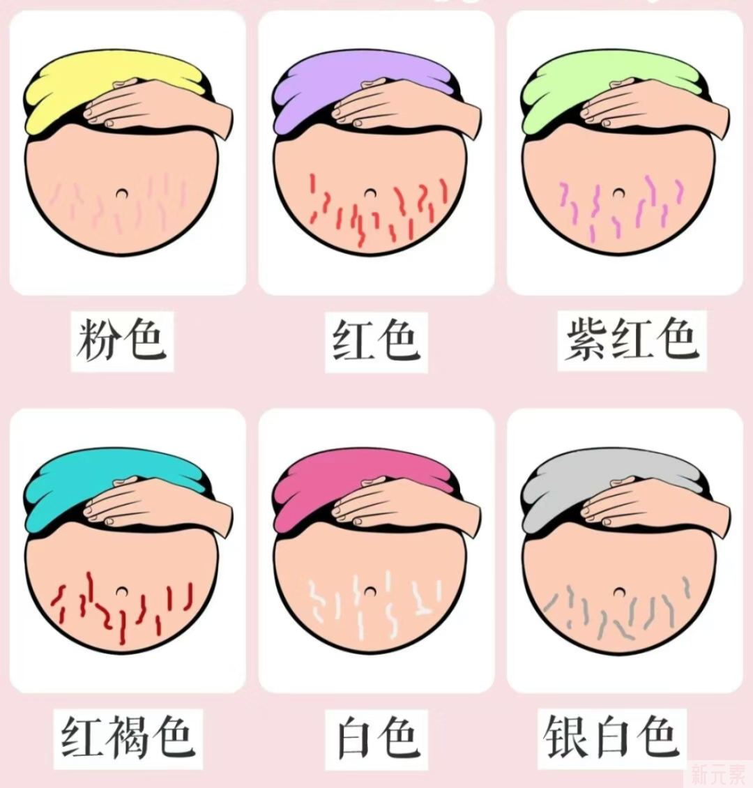 怎么淡化妊娠纹?别再走弯路了! 图片-13