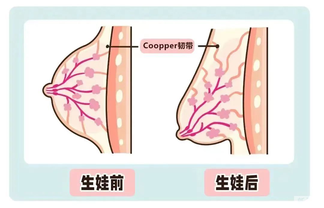 20岁~50岁，不同年龄隆胸，选哪款假体性价比更高? 图片-5