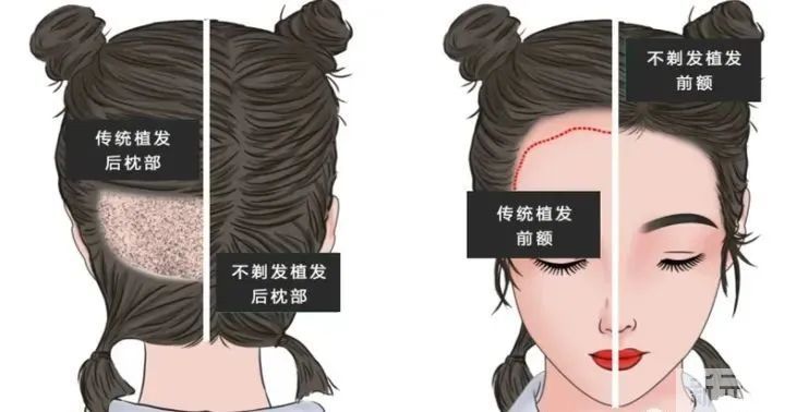 深圳剃发与不剃发植发哪种方式更适合你?它们各自的优劣势是什么?我该怎么选择? 图片-1