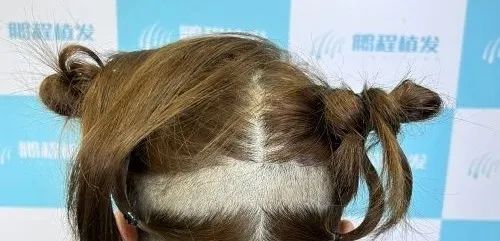 深圳剃发与不剃发植发哪种方式更适合你?它们各自的优劣势是什么?我该怎么选择? 图片-4